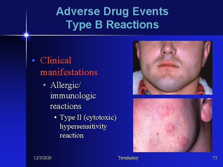 Adverse Drug Events Type B Reactions • Clinical manifestations • Allergic/ immunologic reactions •