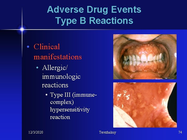 Adverse Drug Events Type B Reactions • Clinical manifestations • Allergic/ immunologic reactions •