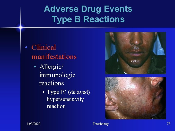 Adverse Drug Events Type B Reactions • Clinical manifestations • Allergic/ immunologic reactions •
