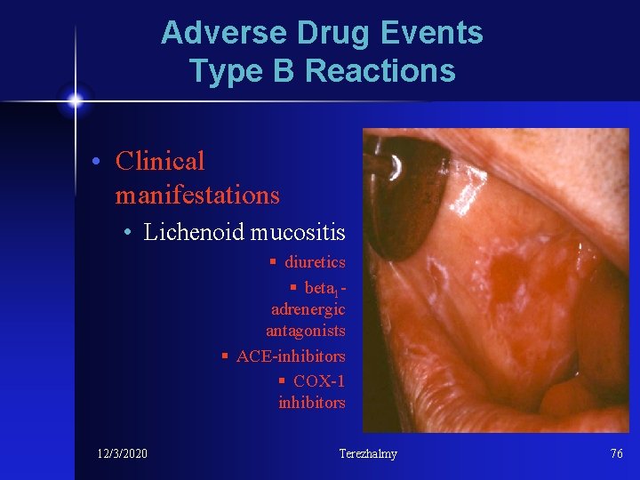 Adverse Drug Events Type B Reactions • Clinical manifestations • Lichenoid mucositis § diuretics