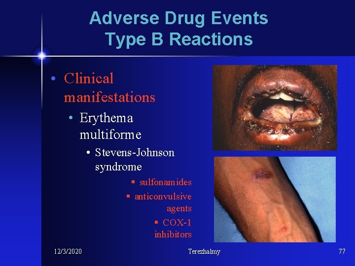 Adverse Drug Events Type B Reactions • Clinical manifestations • Erythema multiforme • Stevens-Johnson