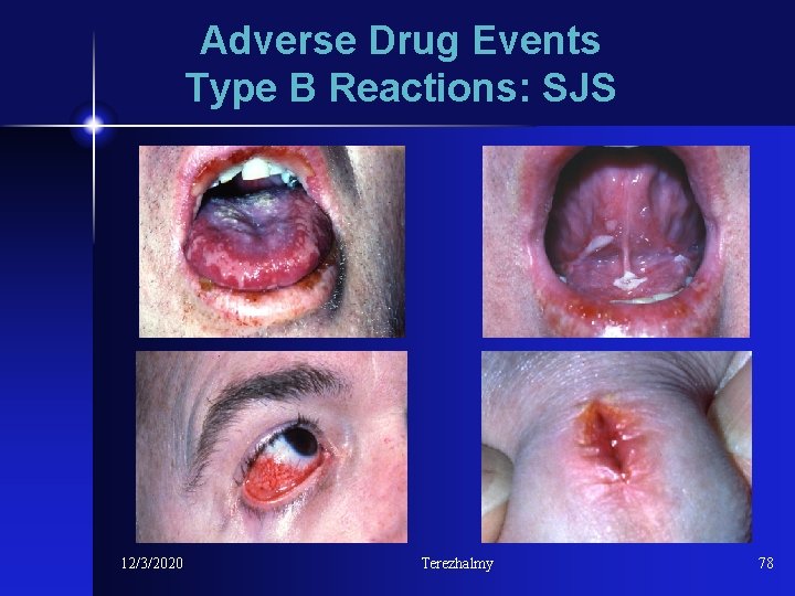 Adverse Drug Events Type B Reactions: SJS 12/3/2020 Terezhalmy 78 