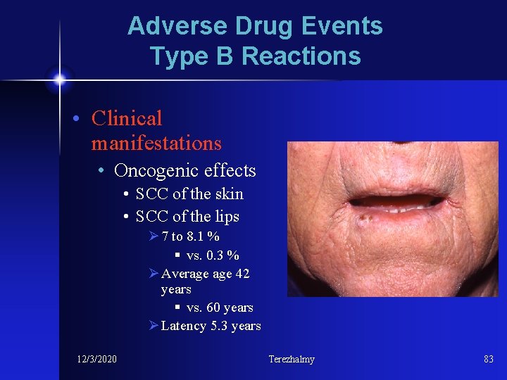 Adverse Drug Events Type B Reactions • Clinical manifestations • Oncogenic effects • SCC