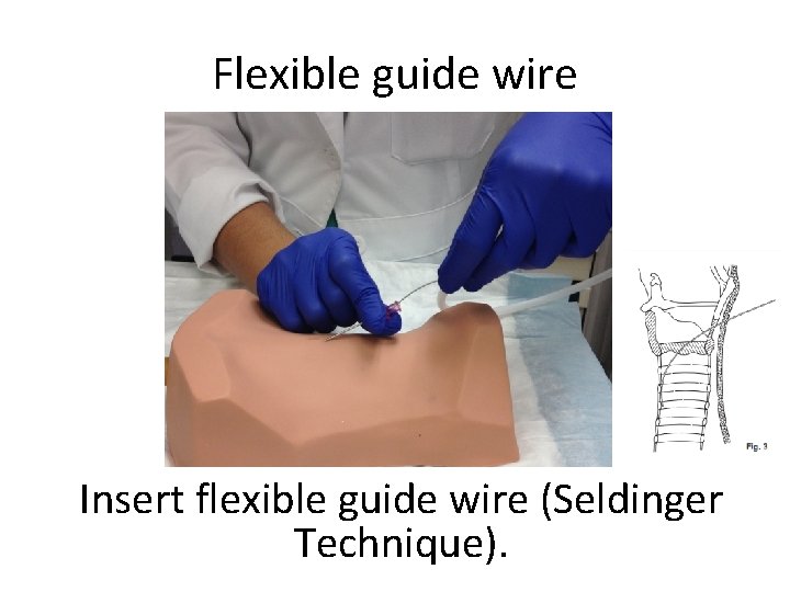 Flexible guide wire Insert flexible guide wire (Seldinger Technique). 
