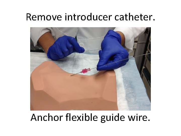 Remove introducer catheter. Anchor flexible guide wire. 