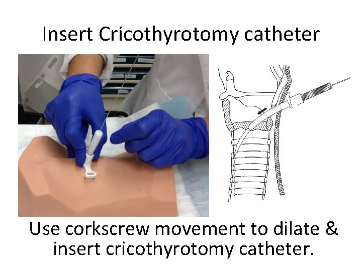 Insert Cricothyrotomy catheter Use corkscrew movement to dilate & insert cricothyrotomy catheter. 
