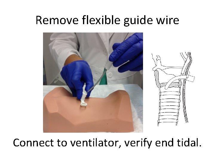 Remove flexible guide wire Connect to ventilator, verify end tidal. 