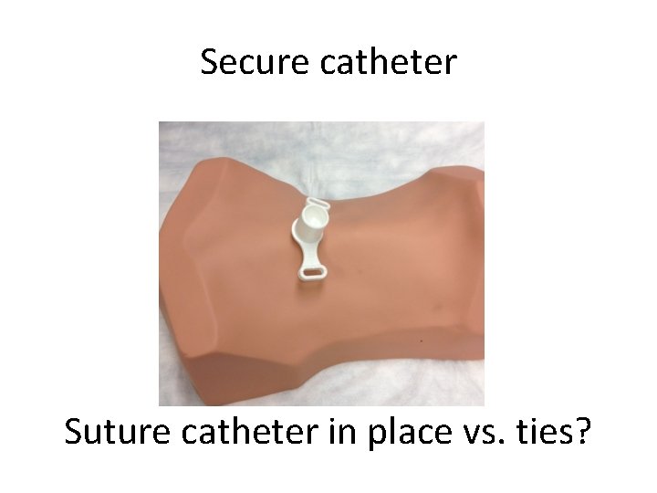 Secure catheter Suture catheter in place vs. ties? 