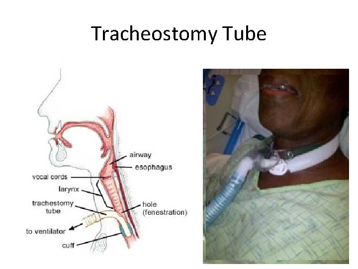 Tracheostomy Tube Mercado 2011 © 