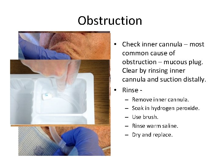 Obstruction • Check inner cannula – most common cause of obstruction – mucous plug.