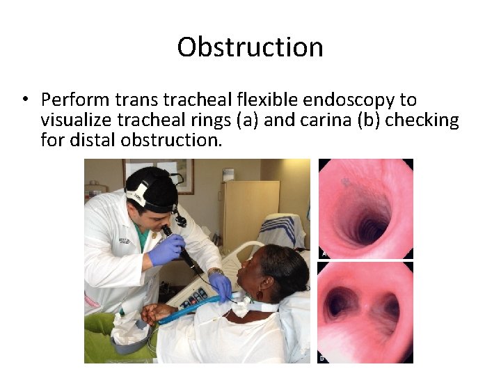 Obstruction • Perform trans tracheal flexible endoscopy to visualize tracheal rings (a) and carina