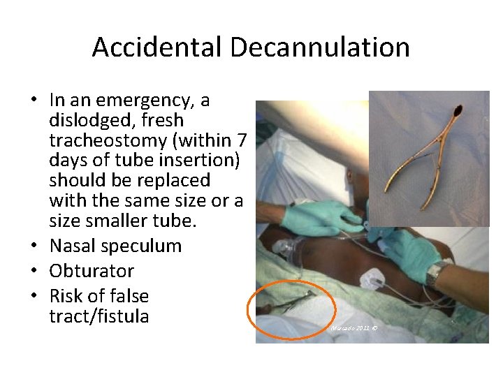 Accidental Decannulation • In an emergency, a dislodged, fresh tracheostomy (within 7 days of