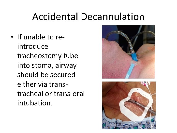 Accidental Decannulation • If unable to reintroduce tracheostomy tube into stoma, airway should be