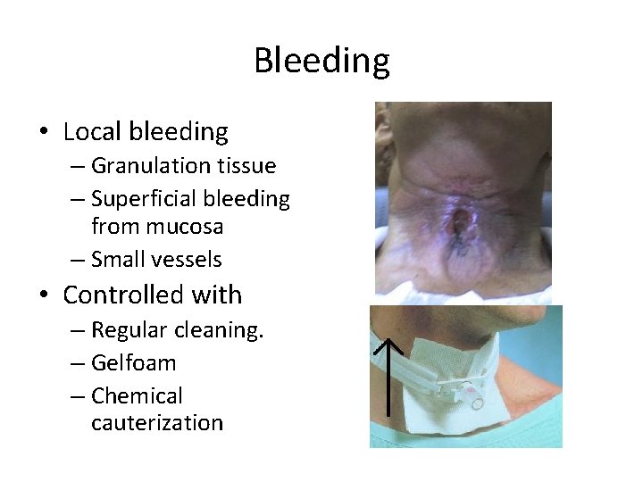 Bleeding • Local bleeding – Granulation tissue – Superficial bleeding from mucosa – Small