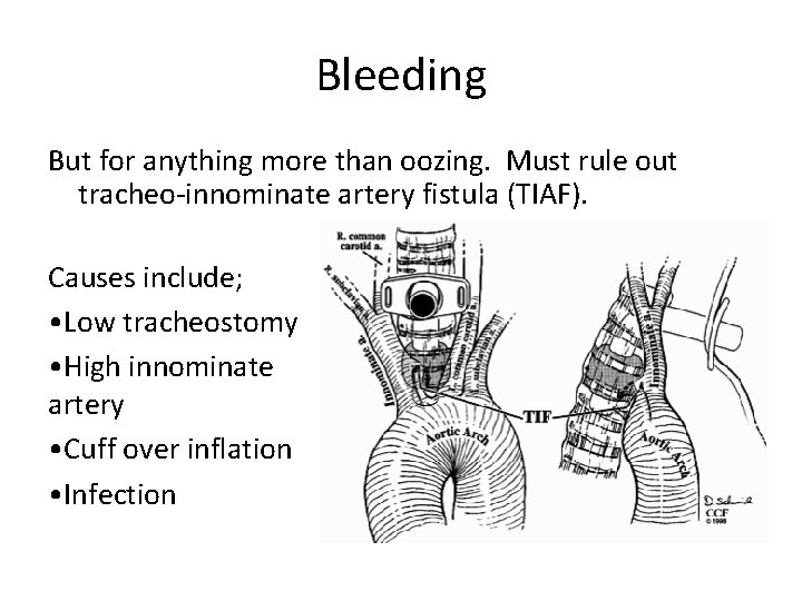 Bleeding But for anything more than oozing. Must rule out tracheo-innominate artery fistula (TIAF).