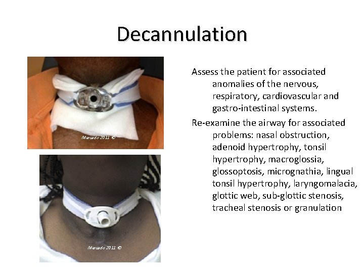 Decannulation Mercado 2011 © Assess the patient for associated anomalies of the nervous, respiratory,