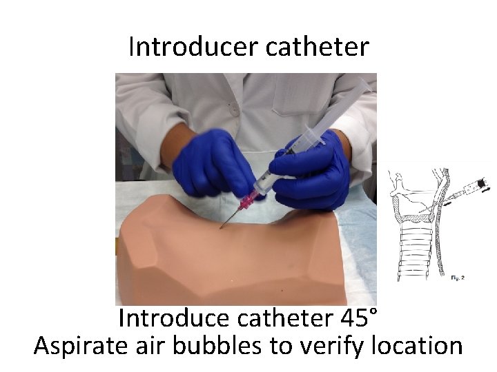 Introducer catheter Introduce catheter 45° Aspirate air bubbles to verify location 