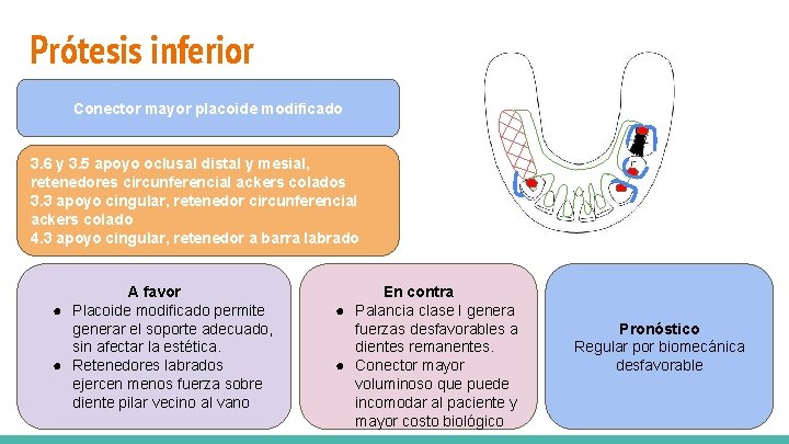 Prótesis inferior Zonas de soporte: Reborde desdentado y dientes pilares 1. 6 y 2.