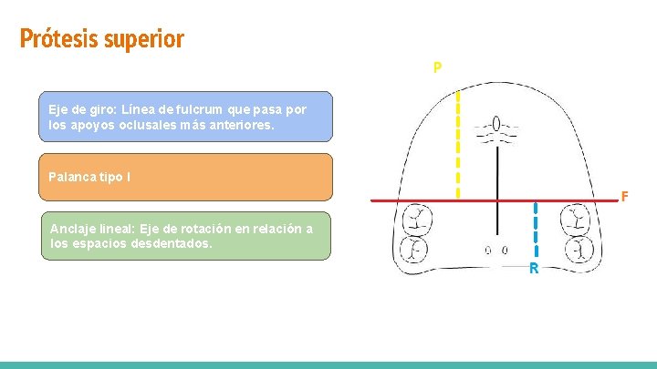 Prótesis superior Vía de carga mixta Eje de giro: Línea de fulcrum que pasa