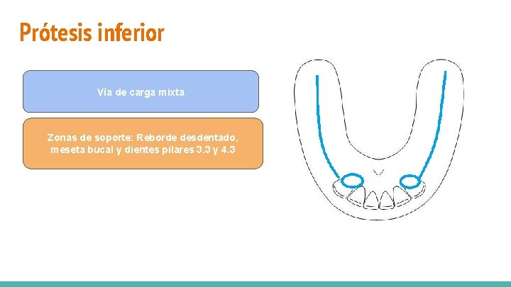 Prótesis inferior Zonas de soporte: Reborde desdentado y dientes pilares 1. 6 y 2.