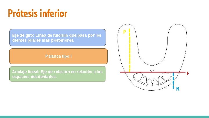 Prótesis inferior Zonas de soporte: Reborde desdentado y dientes pilares 1. 6 y 2.