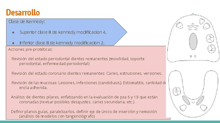 Desarrollo Clase de Kennedy: ● Superior clase II de kennedy modificacion 4. ● Inferior