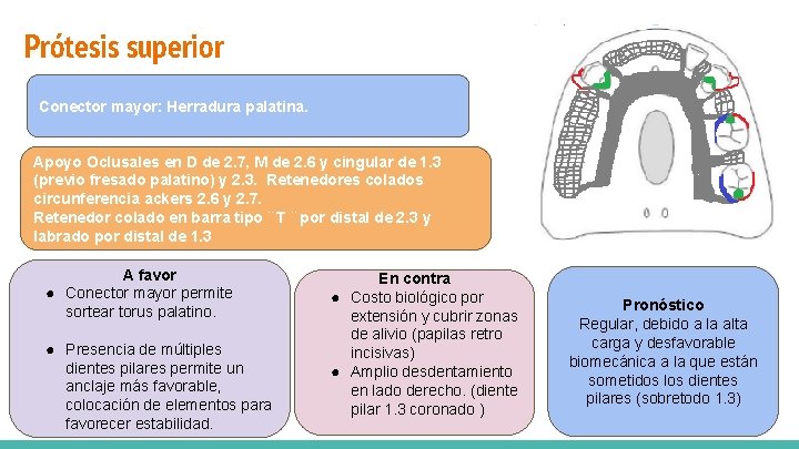 Prótesis superior Conector mayor: Herradura palatina. Vía de carga mixta Apoyo Oclusales en D