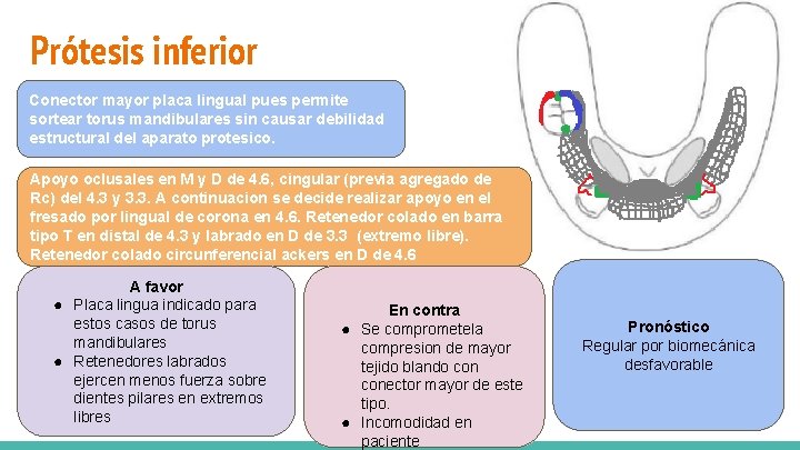 Prótesis inferior Conector mayor placa lingual pues permite sortear torus mandibulares sin causar debilidad