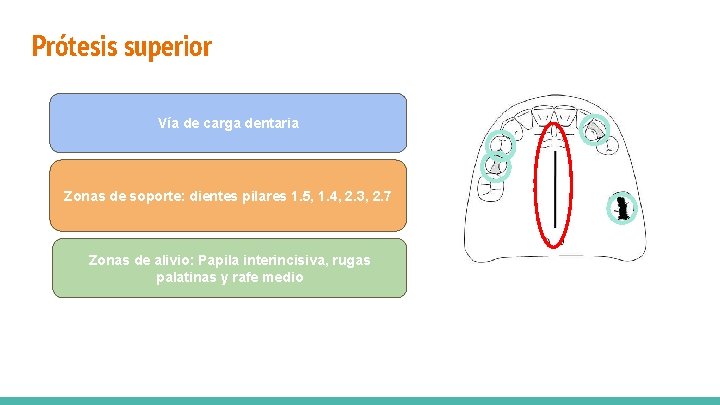 Prótesis superior Vía de carga dentaria Zonas de soporte: dientes pilares 1. 5, 1.