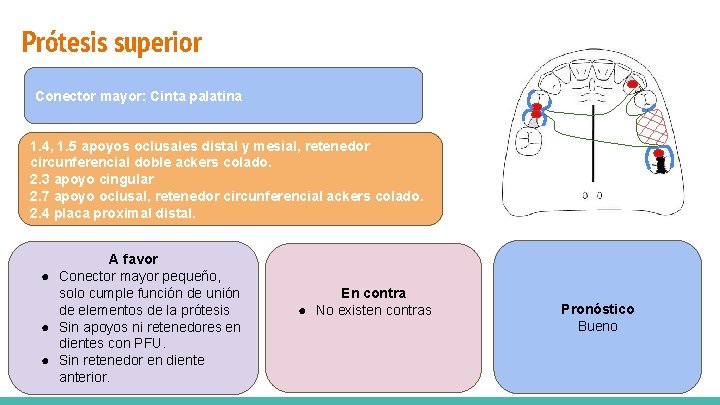 Prótesis superior Conector mayor: Cinta palatina Vía de carga mixta 1. 4, 1. 5