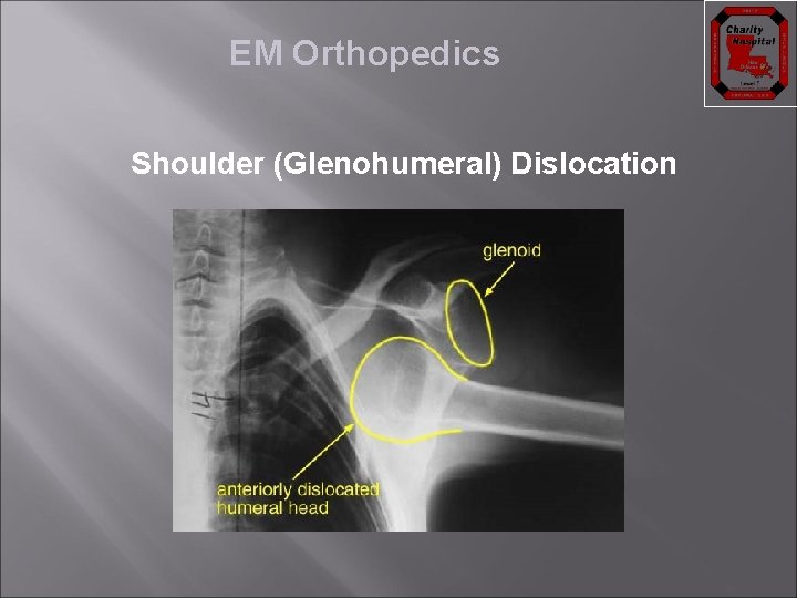 EM Orthopedics Shoulder (Glenohumeral) Dislocation 