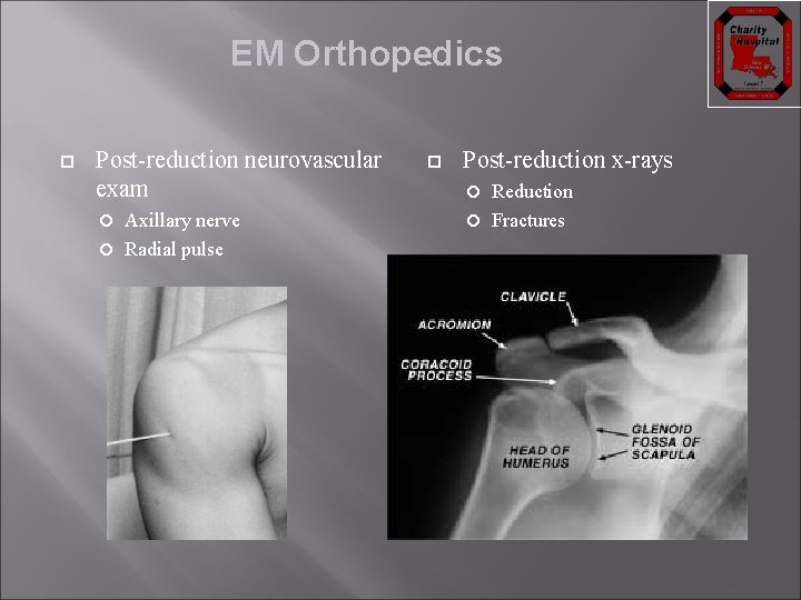 EM Orthopedics Post-reduction neurovascular exam Axillary nerve Radial pulse Post-reduction x-rays Reduction Fractures 