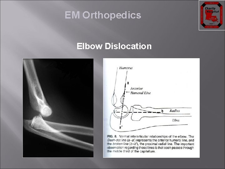 EM Orthopedics Elbow Dislocation 