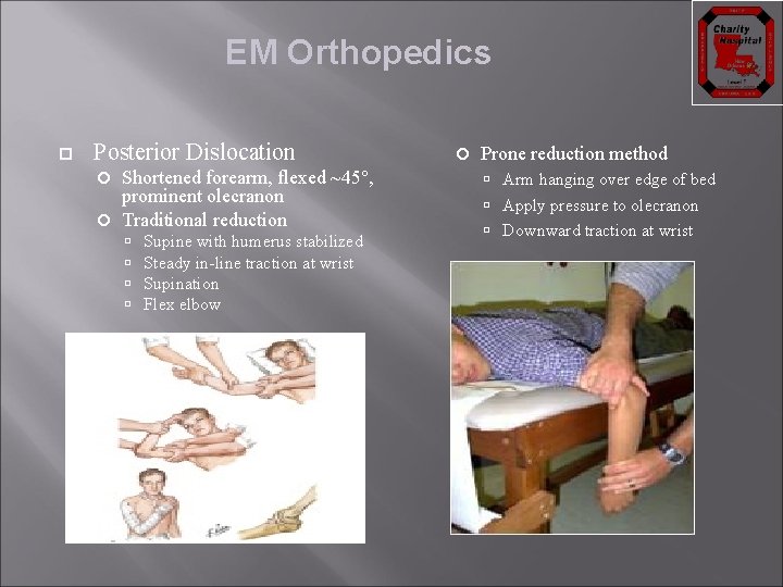 EM Orthopedics Posterior Dislocation Shortened forearm, flexed ~45°, prominent olecranon Traditional reduction Supine with