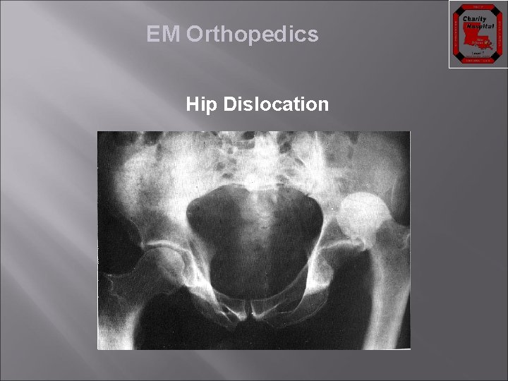 EM Orthopedics Hip Dislocation 
