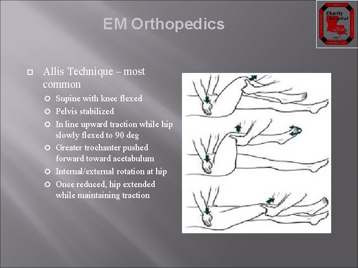 EM Orthopedics Allis Technique – most common Supine with knee flexed Pelvis stabilized In