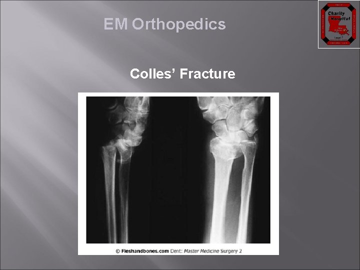 EM Orthopedics Colles’ Fracture 