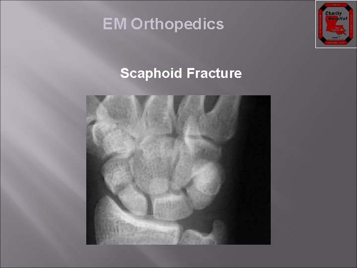 EM Orthopedics Scaphoid Fracture 