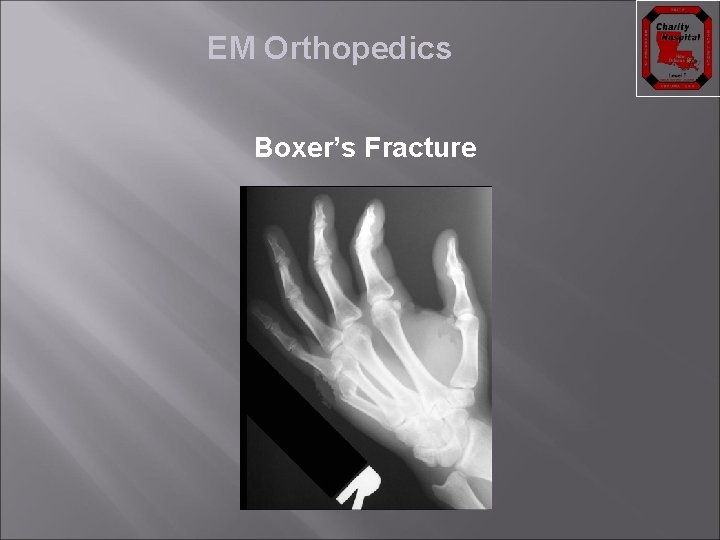 EM Orthopedics Boxer’s Fracture 