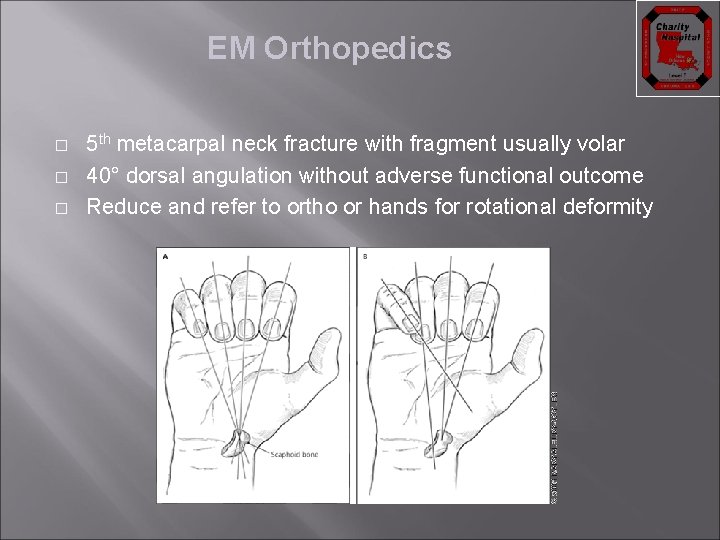 EM Orthopedics � � � 5 th metacarpal neck fracture with fragment usually volar