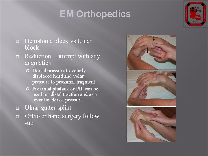 EM Orthopedics Hematoma block vs Ulnar block Reduction – attempt with any angulation Dorsal