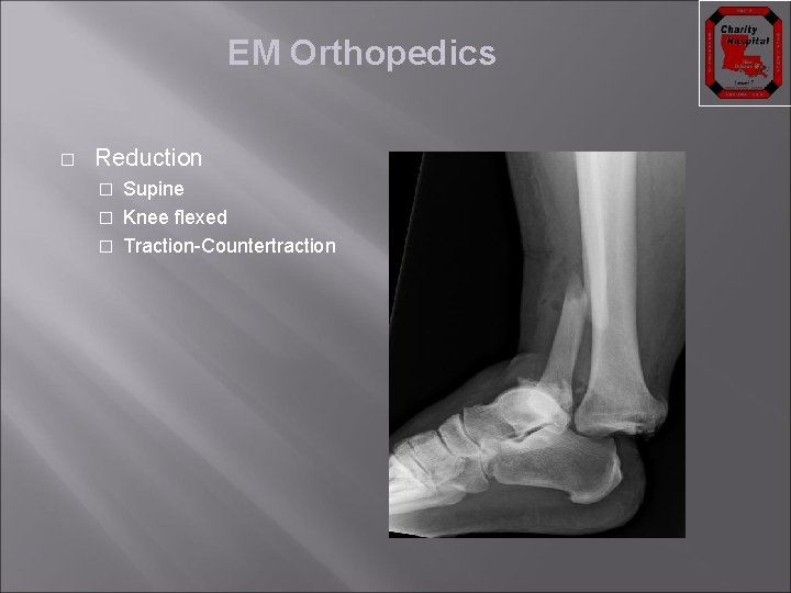 EM Orthopedics � Reduction Supine � Knee flexed � Traction-Countertraction � 