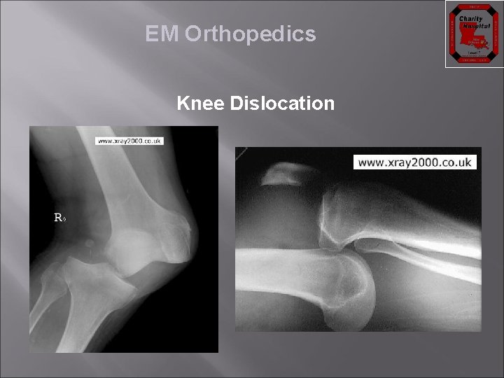 EM Orthopedics Knee Dislocation 