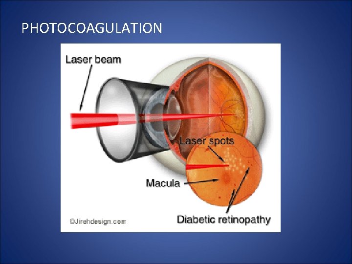 PHOTOCOAGULATION 