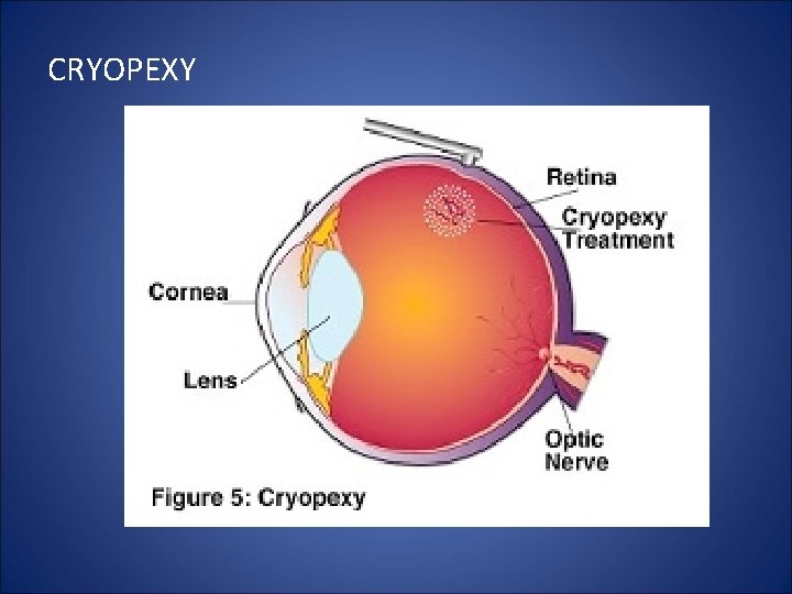 CRYOPEXY 