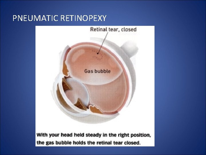 PNEUMATIC RETINOPEXY 