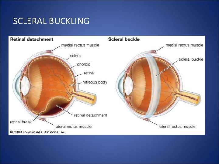 SCLERAL BUCKLING 