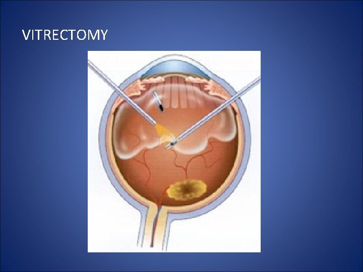 VITRECTOMY 