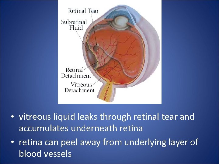  • vitreous liquid leaks through retinal tear and accumulates underneath retina • retina