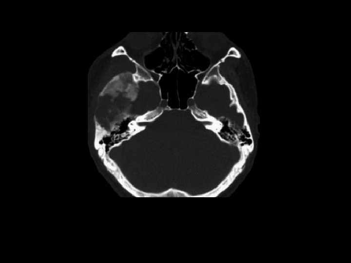 Mixture of dense and radiolucent areas involving the greater wing of the right sphenoid